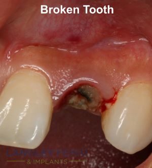broken tooth closeup