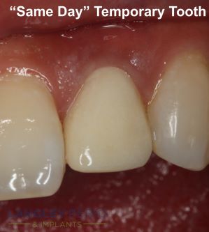 same day temporary tooth