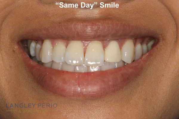 same day implant results