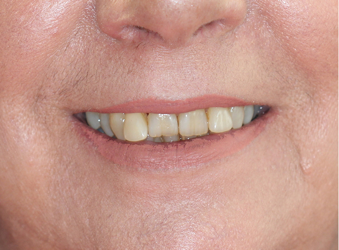 close up of a real patient's smile
