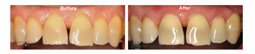 before and after real patient