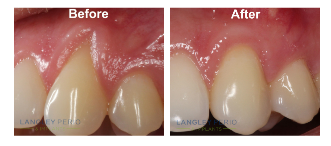 gum graft real results