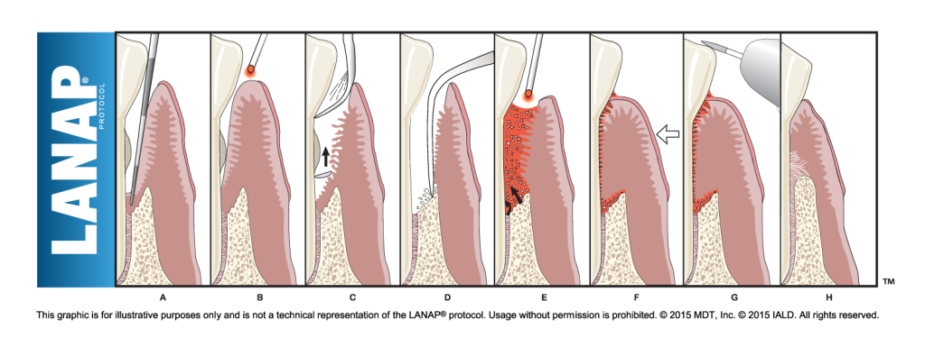 LANAP steps