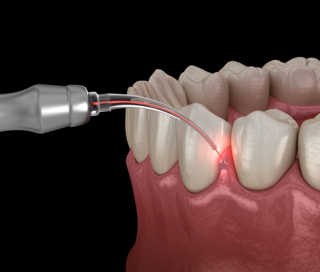 close up of laser dentistry model