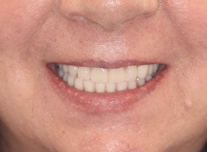 close up of patient's smile