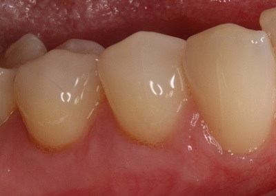 after gum grafting real patient
