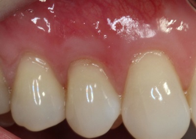 after gum graft real patient