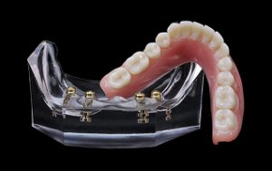 all on 4 implant model