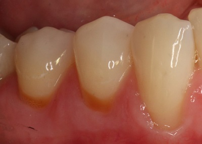 before gum graft real patient