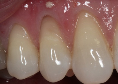 before gum graft real patient