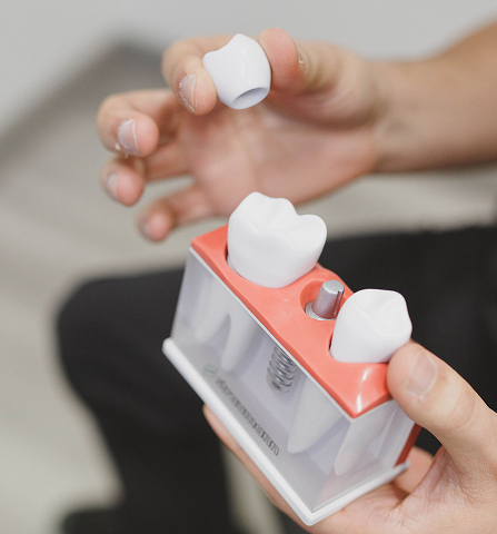 model of a tooth implant