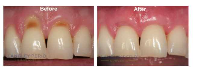 before and after gingival graft patient