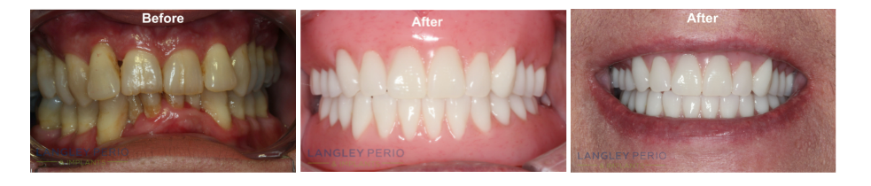 real patient dental implant results